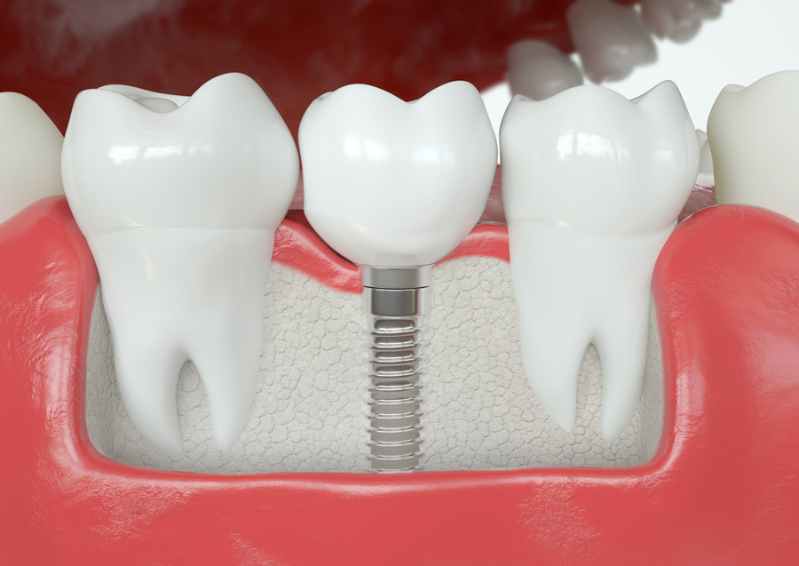 How Does a Fixed Dental Implant Bridge Work