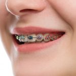 How Much Do Ceramic Braces Cost in 2018