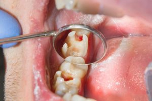 ¿Cómo se puede tener un agujero en el diente