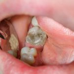 How to Fix Rotting Teeth and 5 Best Ways to Prevent Rot