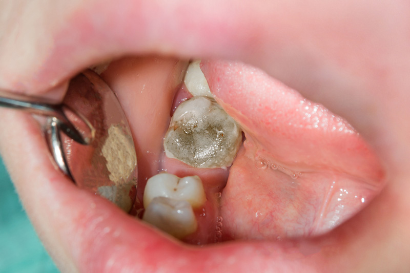 Rotten Teeth? Try These Five Ways To Fix Them!