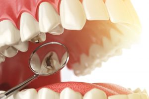 Cómo prevenir los daños en la dentadura
