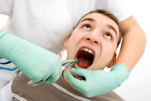 How to Prevent Dry Socket after a Tooth Extraction