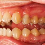 How to Remove Tartar from Teeth Without a Dentist- Tips to Control Tartar Buildup