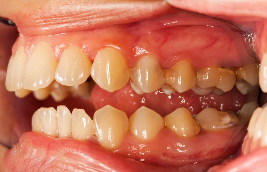 Plaque Vs. Tartar: Buildup, Removal, And Dental Hygiene Tips