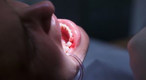 How to treat bleeding gums