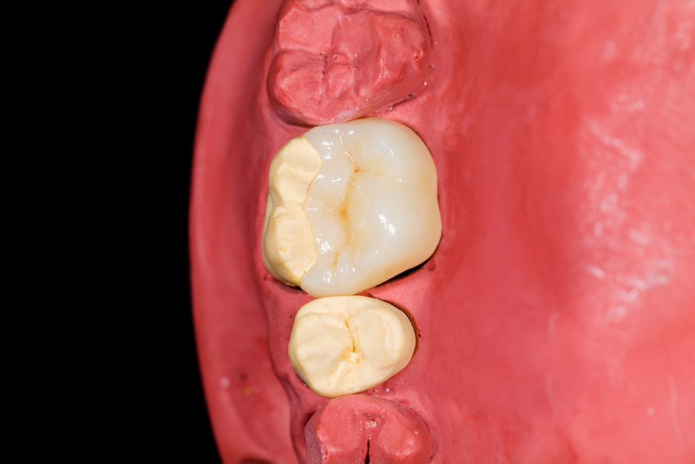 Inlay vs. Onlay Which Is Right for You