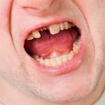 Loose Adult Tooth Here's What to Do