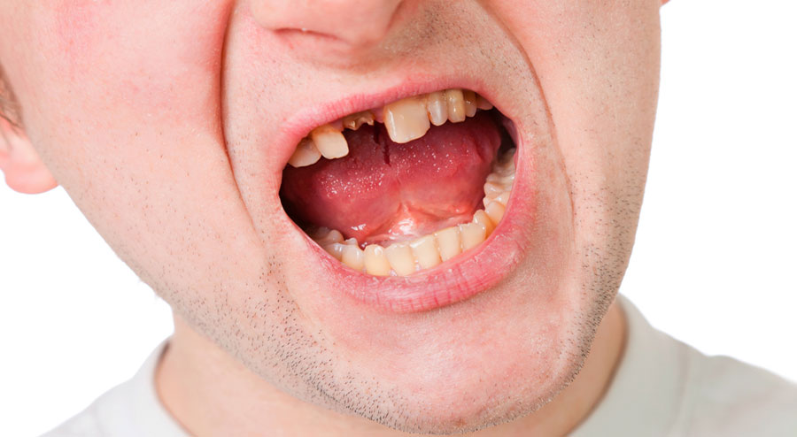Loose Adult Tooth Here's What to Do