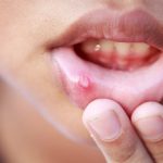 Natural Remedies for Toddler Mouth Sores