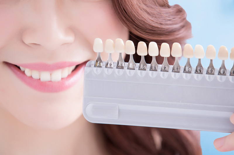 Non-Permanent Veneers