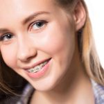 Overbite vs. Underbite A Beginner's Overview