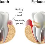 Periodontal Disease Stages