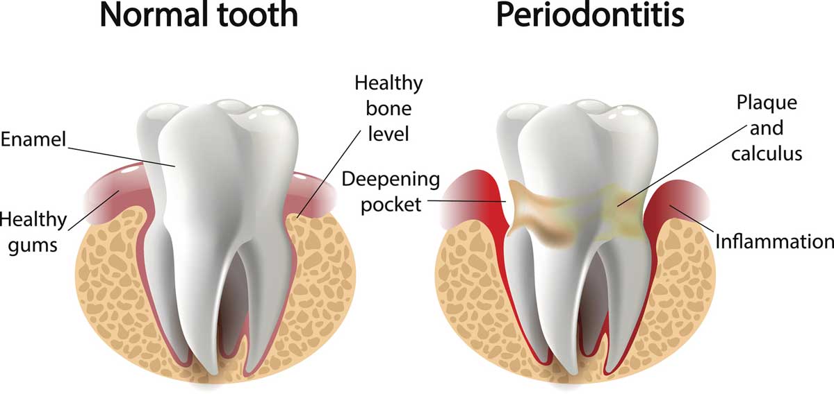 Image result for Periodontal disease