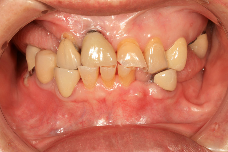 Periodontitis