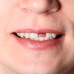 Replace Missing Front Tooth