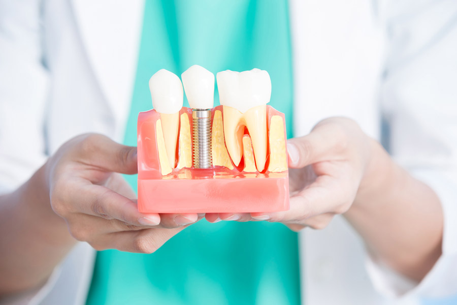 Same Day Dental Implants Review