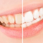 Signs and Symptoms of Clear Teeth