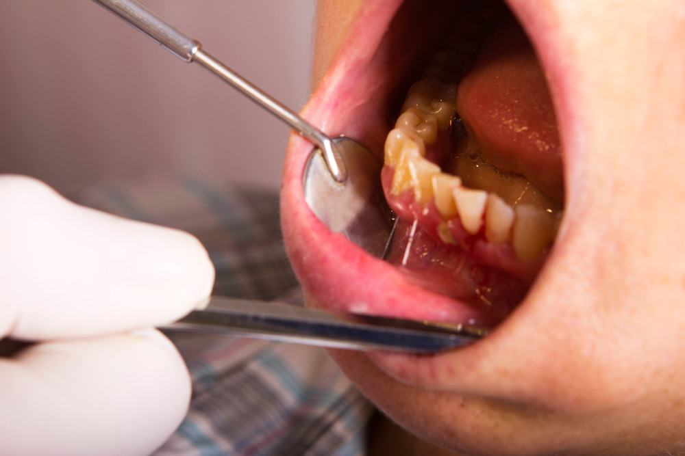 Signs and Treatment for Gingivitis