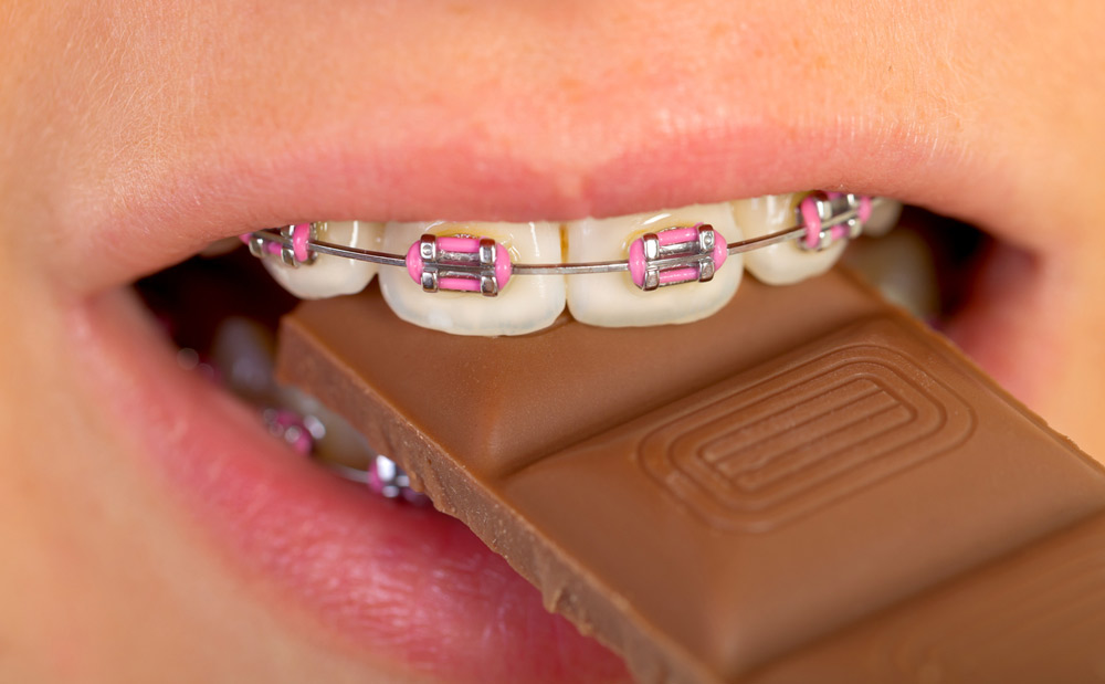 Food to Eat with Braces: What You Can & Can't Eat with Braces in 2018