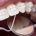 Swollen Gums With Braces- What Does it Mean for Your Oral Health