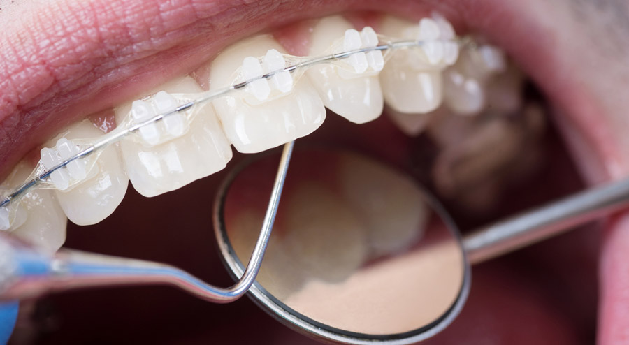 Your Gums May Need A Little Extra Care While You Re Wearing Braces