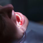 Teeth Bleeding Causes and At-Home Remedies