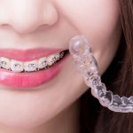 Teeth Straightening Options for Adults What Are My Options in 2018