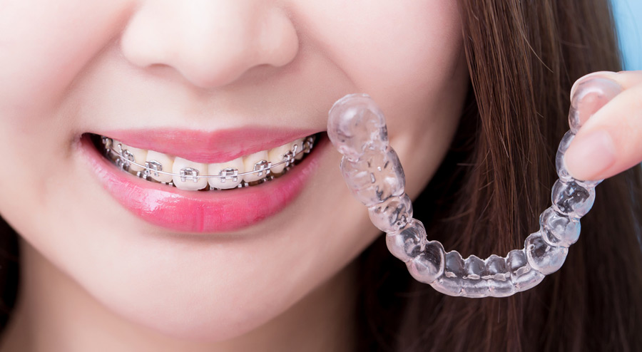 Teeth on sale straightening options