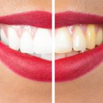 Teeth Whitening Services and Methods What's Your Best Option