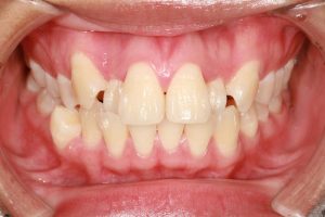 Teeth crowding