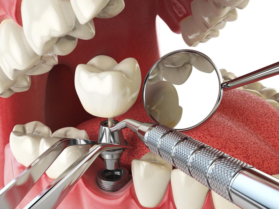 The Benefits of Performing Same Day Dental Implants