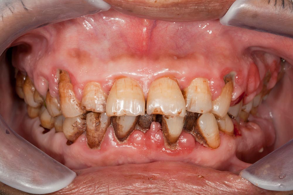 Tartar teeth