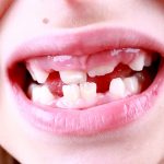 The Most Common Causes of White Spots on Baby Teeth & How to Prevent Them