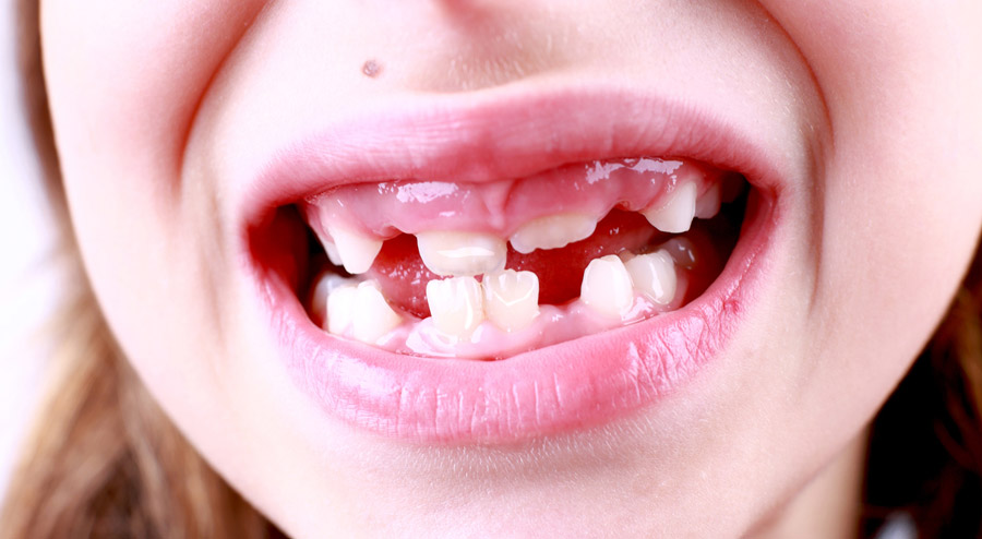 The Most Common Causes of White Spots on Baby Teeth & How to Prevent Them