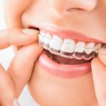 Transparent Teeth Info and FAQs