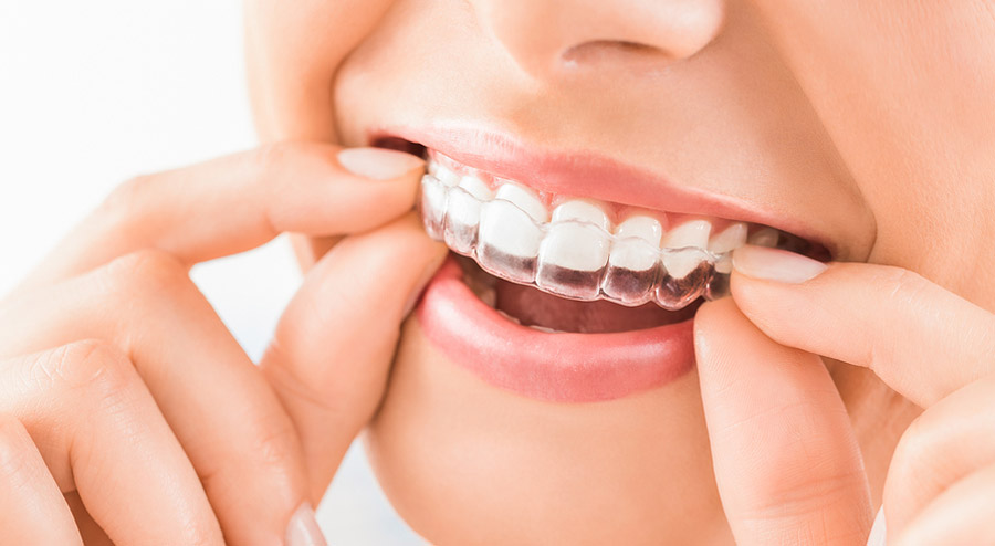 Transparent Teeth Info and FAQs