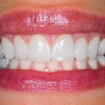 What Are Porcelain Veneers