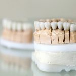 What Are the Different Types of Veneers