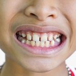 What Causes Gap Teeth and Can You Create a Gap