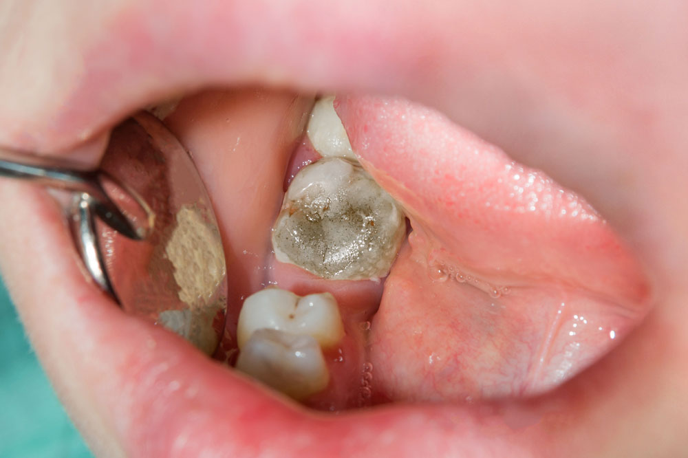 What Do Rotten Teeth Look Like 