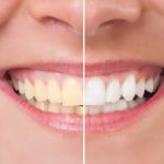 What Does a Teeth Whitening Dentist Do