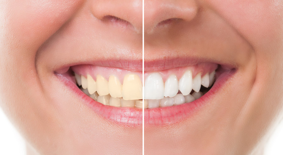 What Does a Teeth Whitening Dentist Do