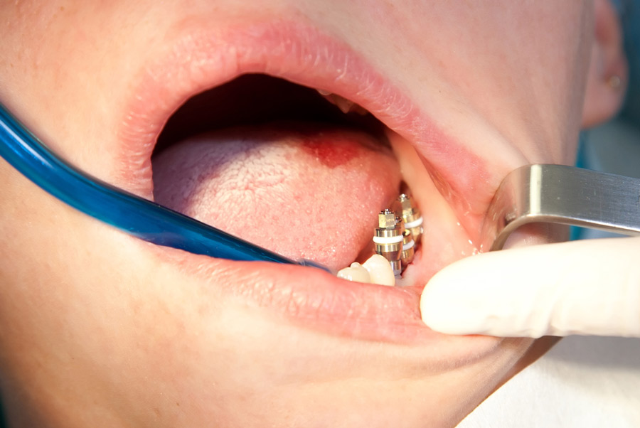 What are Dental Bridges