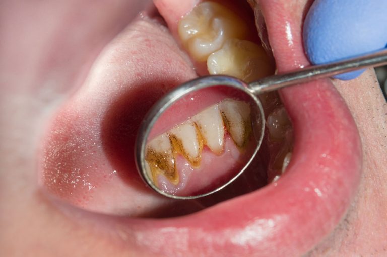 What Do Rotten Teeth Look Like?