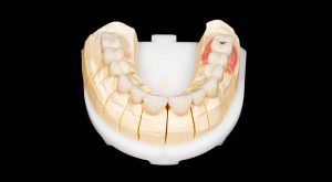 What are the advantages and disadvantages of zirconia crowns