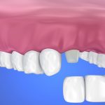 What is Tooth Cement and How Does It Work