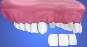 What is Tooth Cement and How Does It Work?
