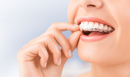 What to Expect from Invisalign