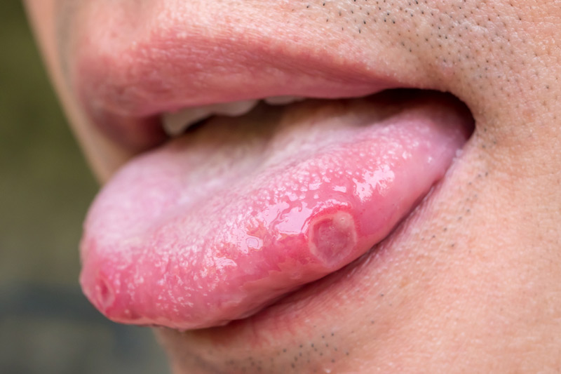 Where Do Mouth Sores Come From